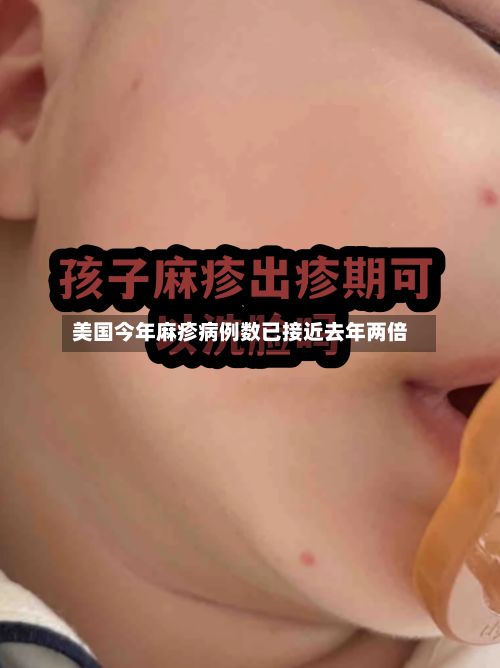 美国今年麻疹病例数已接近去年两倍-第2张图片