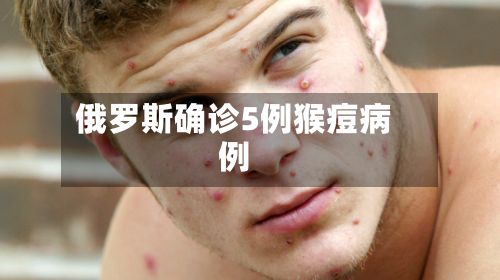 俄罗斯确诊5例猴痘病例-第2张图片